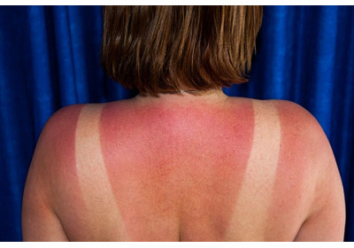 S.O.S Coups de Soleil 2 recettes simples