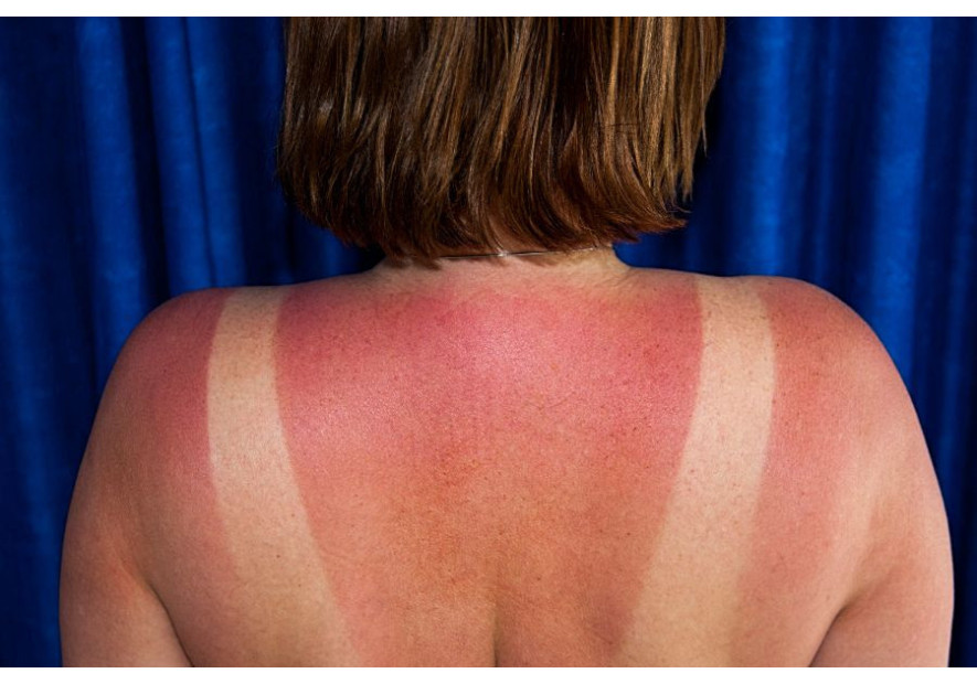 S.O.S Coups de Soleil 2 recettes simples